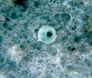 Dizenterija ameba