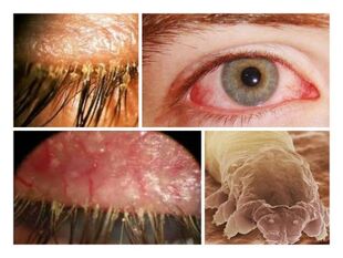 parazitų buvimo po žmogaus oda simptomai